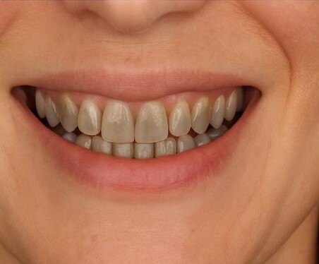 Before Treatment