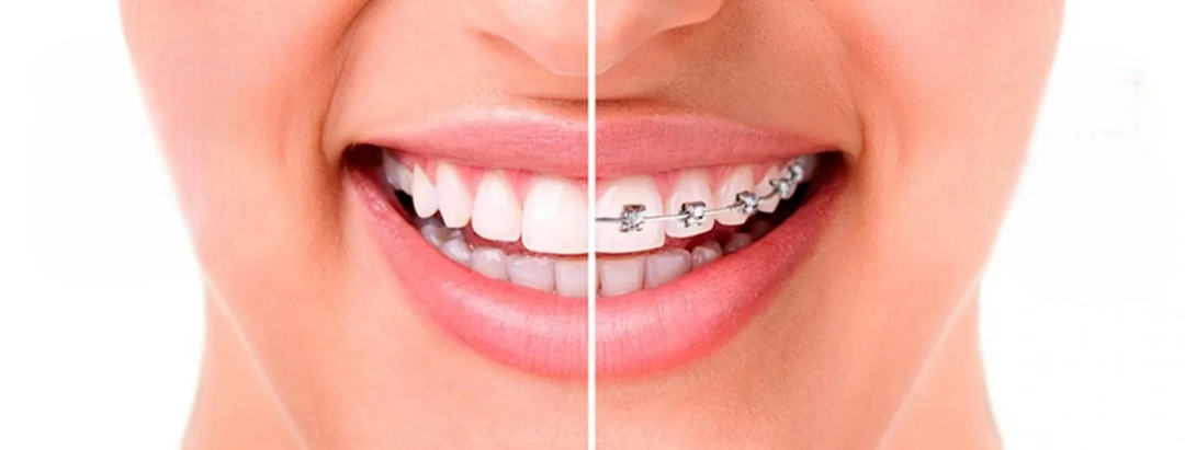 Braces and aligners