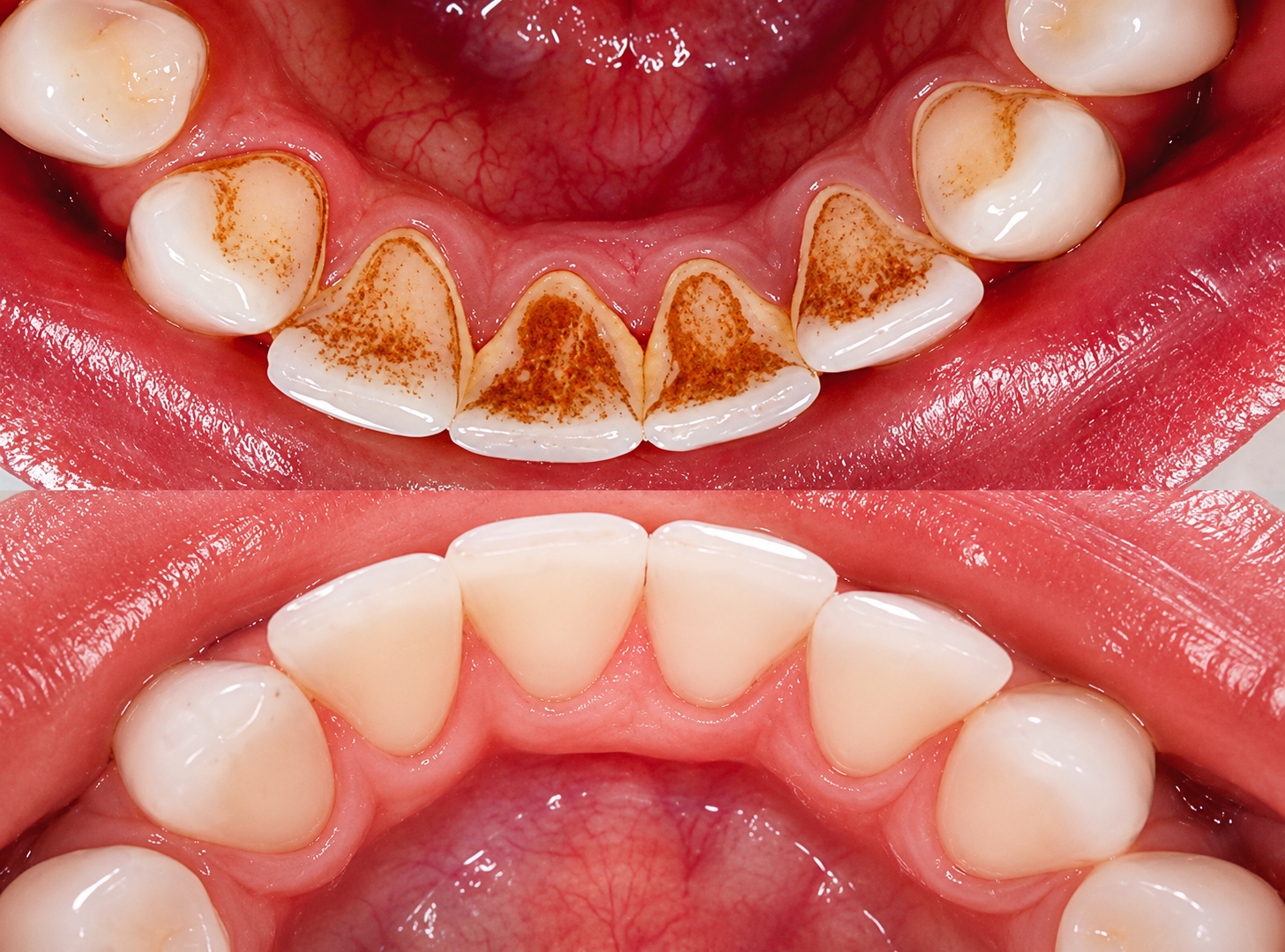 Teeth Cleanings