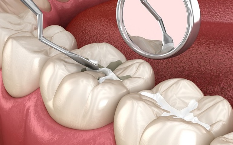 Pit & Fissure Sealants