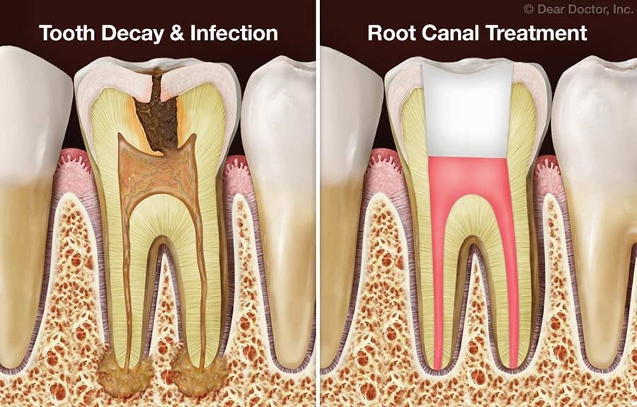 Root Canal Therapy