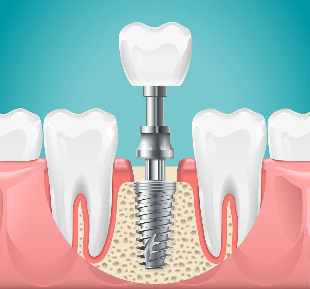 Implant Surgeries
