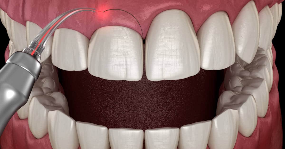Laser Dentistry