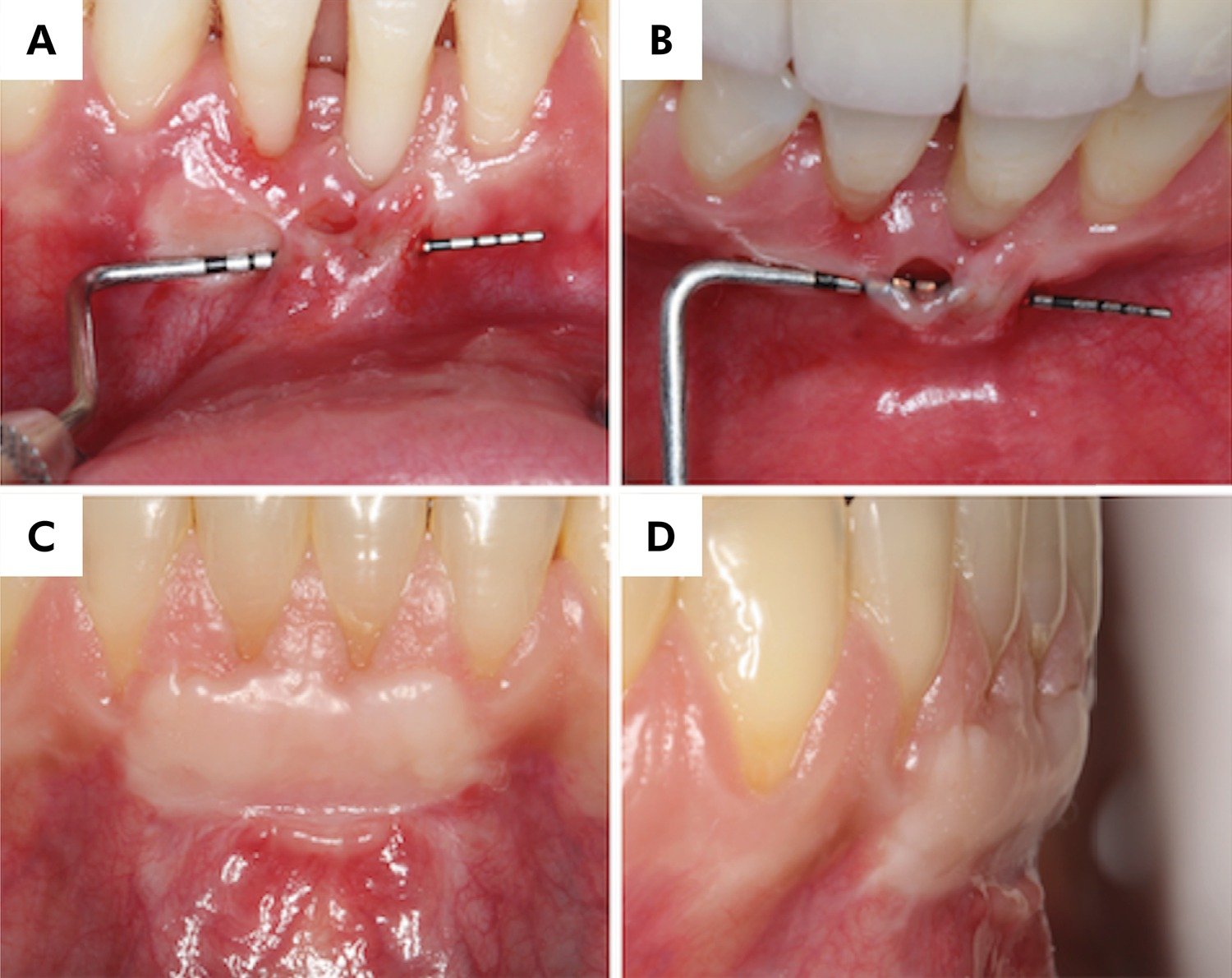 Periodontal surgeries
